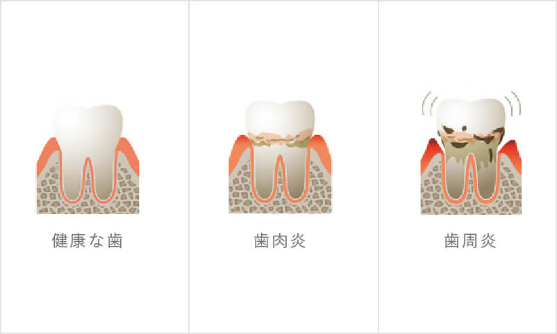 歯周病について3